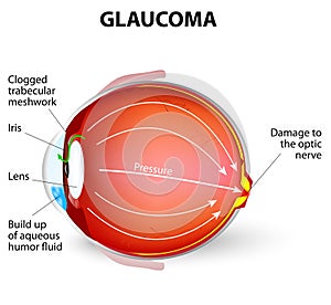 Glaucoma photo