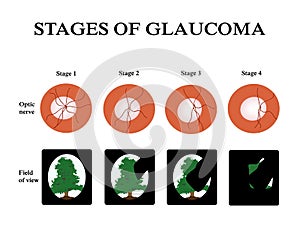 Glaucoma. The field of vision in glaucoma. Atrophy of the optic nerve. Infographics. Vector illustration photo