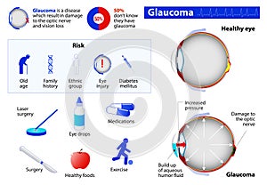 Glaucoma photo