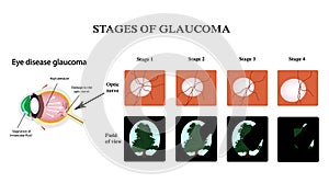Glaucoma. The structure of the eye. The field of vision in glaucoma. Atrophy of the optic nerve. Infographics. Vector photo