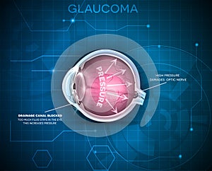 Glaucoma, vision disorder photo