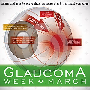 Glaucoma Week Design with a Description of this Ocular Disease, Vector Illustration