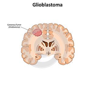 Glioblastoma vector illustration
