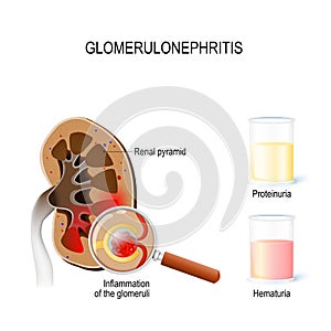 Glomerulonephritis glomerular nephritis. Human kidney, and clo