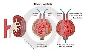 Glomerulonephritis or glomerular nephritis. Kidney disease, inflammation