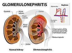 Glomerulonephritis or glomerular nephritis. kidney disease