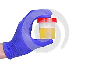 A gloved doctor hand with the urine container for medical urine test. A photo of urine specimen, medical analysis in the laborator