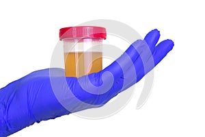 A gloved doctor hand with the urine container for medical urine test. A photo of urine specimen, medical analysis in the laborator