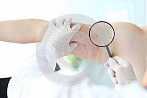 Gloved doctor looking at rash with magnifier