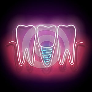 Glow Dentition with Implanted Tooth