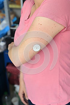 Glucose sensor implanted in the arm of a working woman