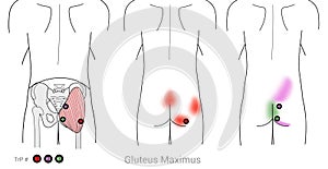 Gluteus maximus: Myofascial trigger points in Gluteus maximus can cause hip and thigh muscle pain