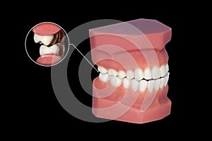 Gnashing of teeth dental molars close up