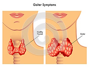 Goiter