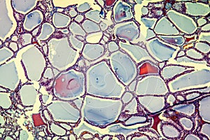 Goiter with colloid thyroid disease