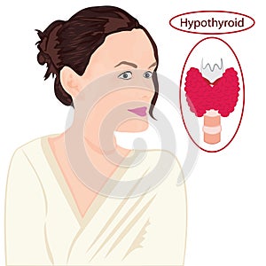 Goiter. Enlarged Thyroid. Endocrine disfunction vector illustration