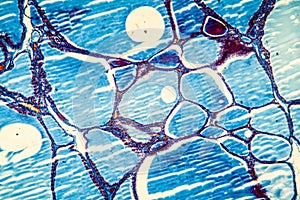 Goiter thyroid tissue with colloid