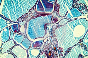 Goiter thyroid tissue with colloid
