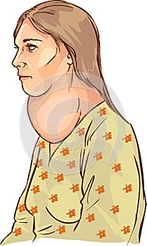Goiter