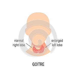 Goitre disease vector