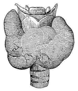 Goitre. Illustration of the 19th century.