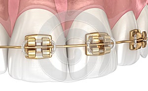 Golden braces tretament, macro view. Medically accurate dental 3D illustration