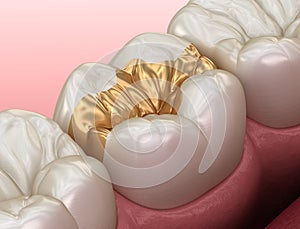 Golden Inlay crown fixation over tooth. Medically accurate 3D illustration of human teeth