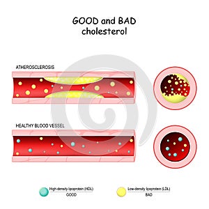 Good HDL and bad LDL cholesterol. Healthy blood vessel and Atherosclerosis