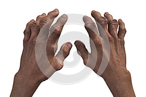 Gout-afflicted hands with deformities, 3D illustration
