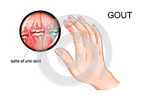 Gout, arthritis of fingers