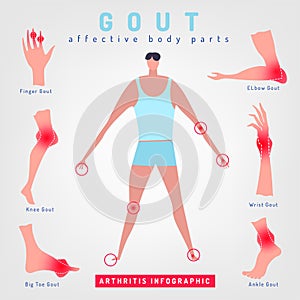 Gout arthritis infographic photo