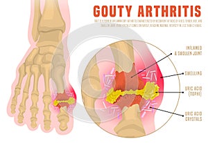 Gout arthritis infographic photo