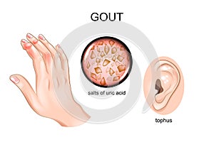 Gout, arthritis, tofus. photo