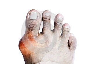 Gout of the big toe