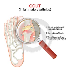 Gout. Close-up of joint with inflammatory arthritis photo