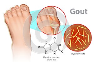 Gout is a form of inflammatory arthritis