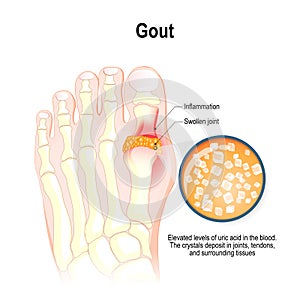 Gout is a form of inflammatory arthritis. photo