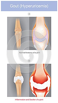 Gout. The illustrated a form of arthritis which can be intensely painful it is caused by having sodium urate crystals in a joints