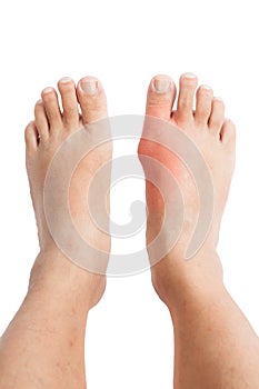 Gout inflammation on the right foot