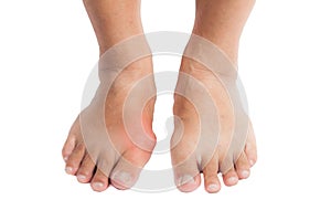 Gout inflammation on the right foot photo