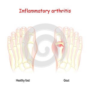 Gout. inflammatory arthritis photo