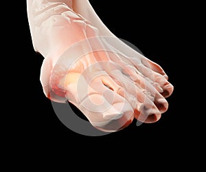 Gout inflammatory arthritis on human feet toe finger