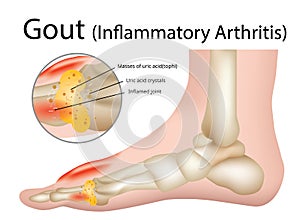 Gout Inflammatory arthritis , Illustration - Vector