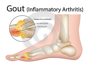 Gout Inflammatory arthritis , Illustration - Vector