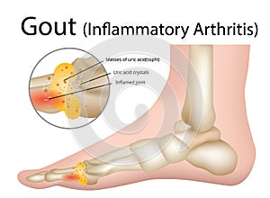 Gout Inflammatory arthritis , Illustration - Vector photo
