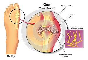 Gout photo