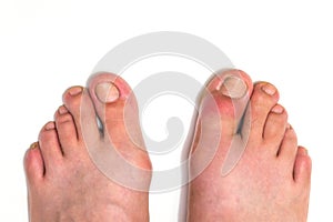 Gout or podagra on the big toe appears as redness and a unbearable pain