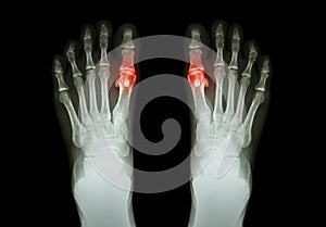 Gout , Rheumatoid arthritis ( Film x-ray both foot and arthritis at first metatarsophalangeal joint ) ( Medicine and Science
