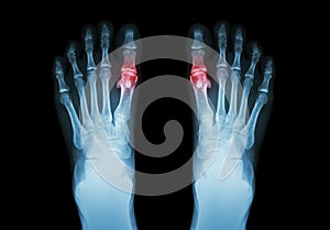 Gout , Rheumatoid arthritis ( Film x-ray both foot and arthritis at first metatarsophalangeal joint ) ( Medicine and Science photo