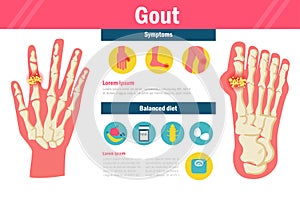 Gout Vector. Cartoon.  art on white background.